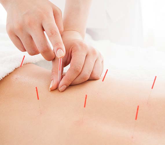 鍼灸（はり・きゅう）